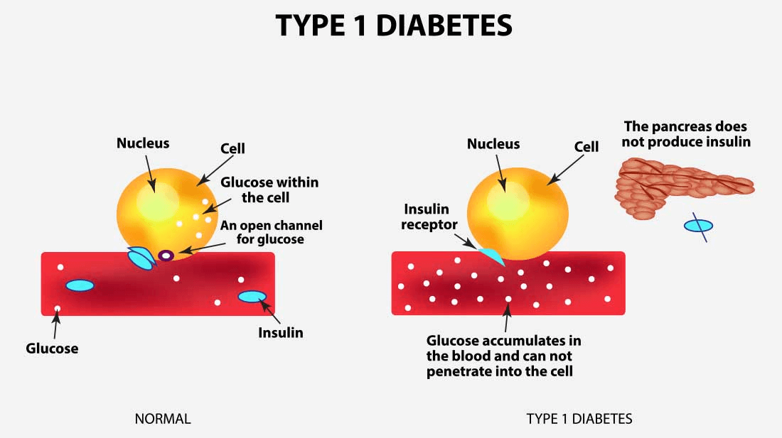 type 1 diabetes)